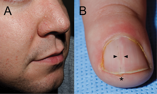 The cutaneous manifestations of tuberous sclerosis complex - Nguyen - 2018  - American Journal of Medical Genetics Part C: Seminars in Medical Genetics  - Wiley Online Library