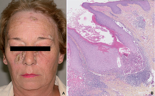 hyperkeratosis papilloma