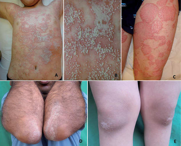 Psoriasis inheritance pattern