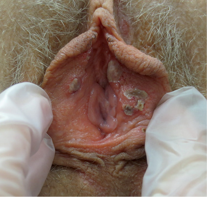 swollen labia minora itchy - MedHelp