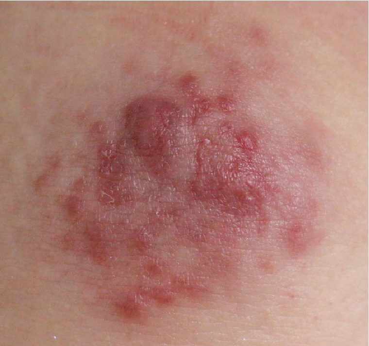 Erythematous Grouped Papules and Plaque on an Intra-articular Injection  Area: A Quiz, HTML
