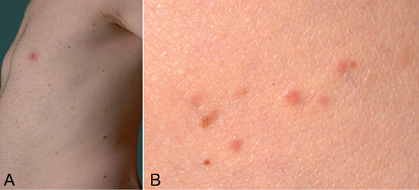 papular rash differential