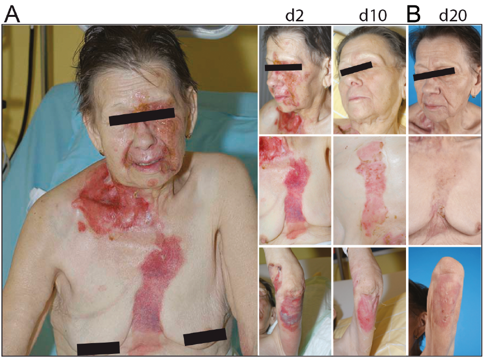 Skin Infections Caused by Staphylococcus aureus, HTML