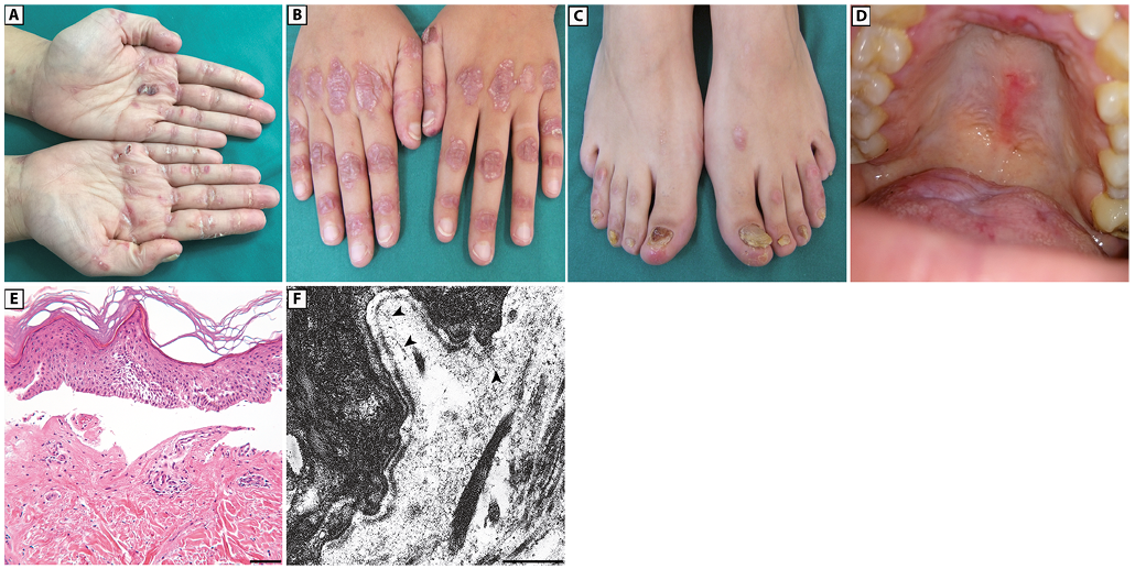 Frontiers  Epidermolysis Bullosa Acquisita: The 2019 Update