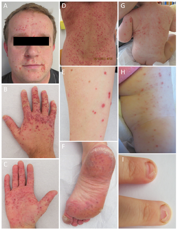 An Adolescent's Exuberant Rash: Is It Hand-Foot-and-Mouth Disease?