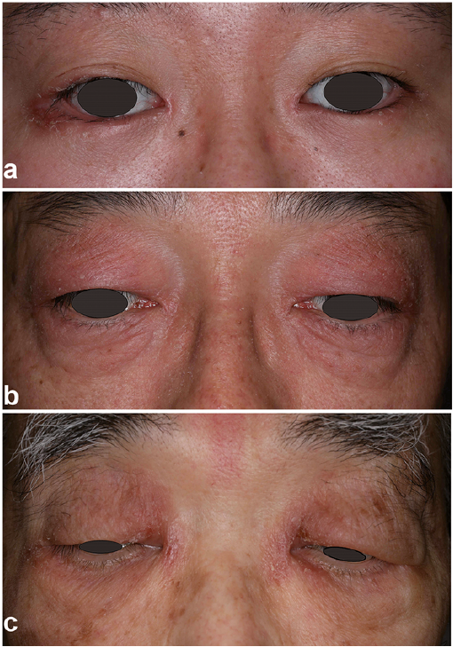 how to treat psoriasis on eyelid)