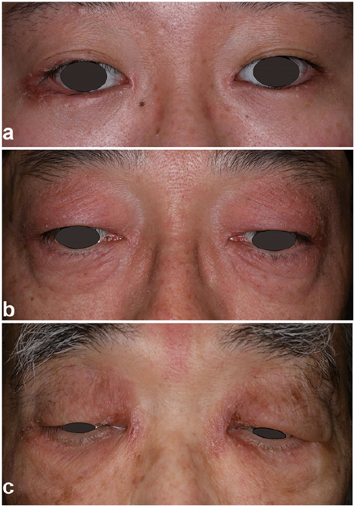 how to treat psoriasis on eyelid