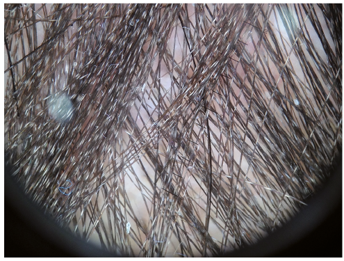 Banded Scalp Hair With An Unusual Glistening Appearance In A Teenager A Quiz Html Acta Dermato Venereologica
