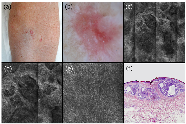 Papillary skin lesion, Papillary lesion b3