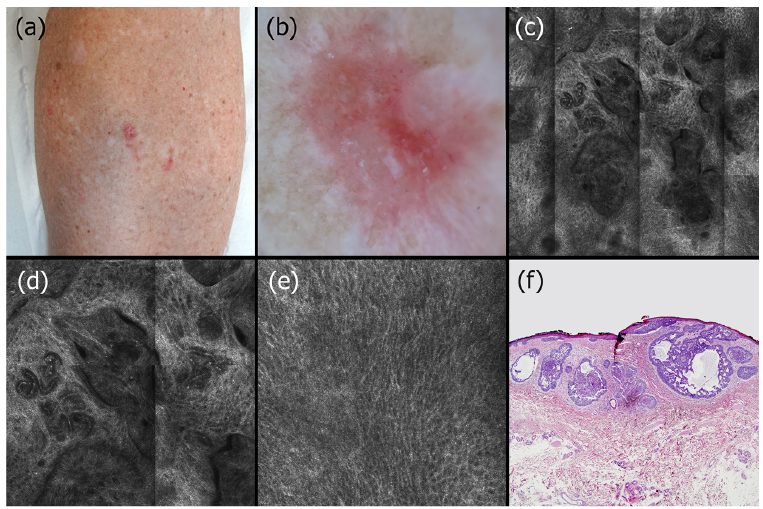 papillary skin lesion