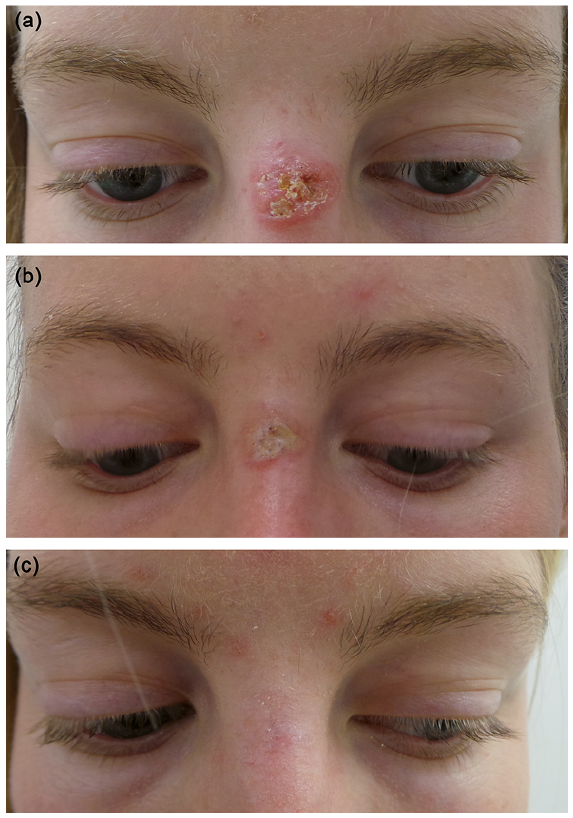 Fractional CO2 laser - LAZEO