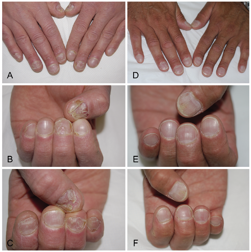 nail psoriasis, topical treatment)