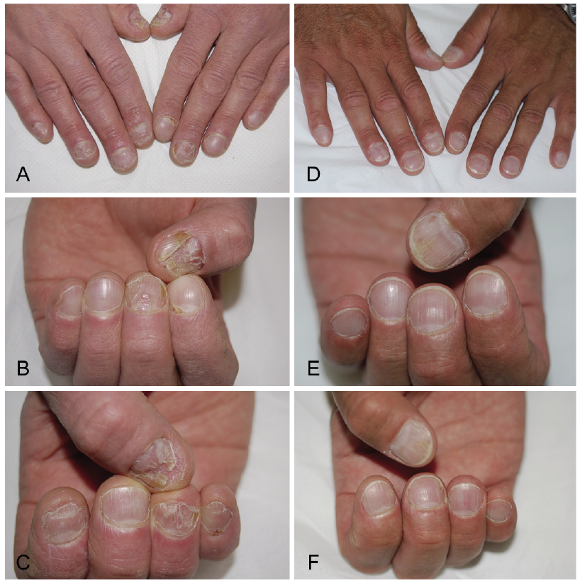 Arthropathic psoriasis osztályozás