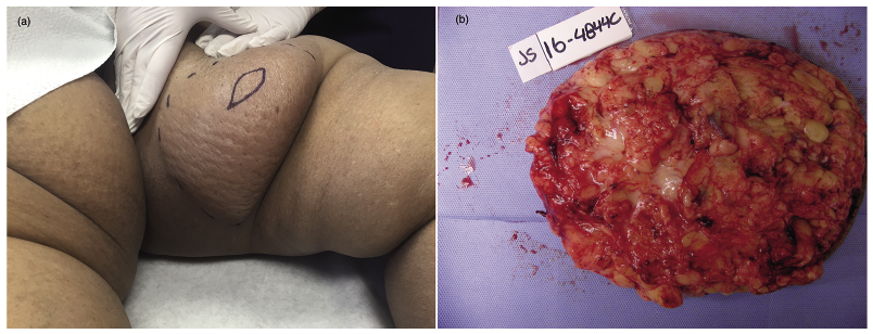 Pseudosarcoma – massive localized lymphoedema in morbidly obese – a rare  entity: Case report - ScienceDirect