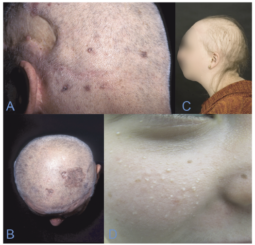 Skin Cancer Associated Genodermatoses A Literature Review Html