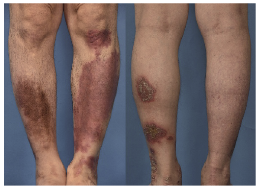 plaque psoriasis remission)