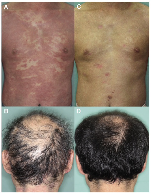 Dupilumab Improved Alopecia Areata in a Patient with Atopic Dermatitis: A Case Report | HTML | Acta Dermato-Venereologica Dupilumab Improved Alopecia Areata in a Patient with Atopic Dermatitis: A Case Report | HTML | Acta Dermato-Venereologica