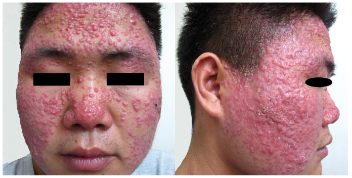 Dense Papules on the Face: A Quiz | HTML | Acta Dermato-Venereologica