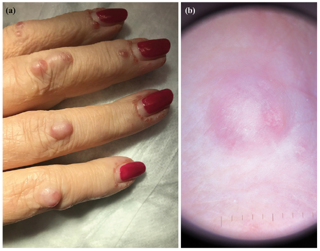 Inflammation and Redness of the Fingernail Folds - Clinical Advisor