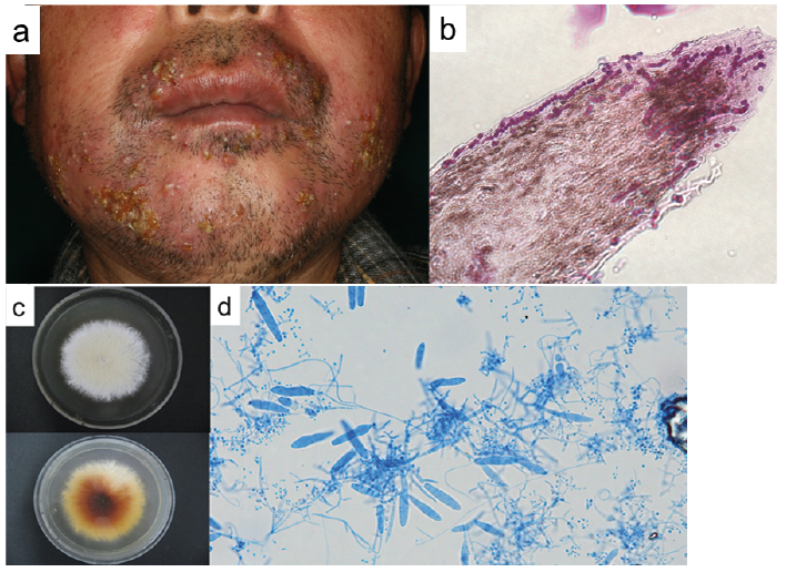 Tinea Barbae due to Trichophyton mentagrophytes Contracted from