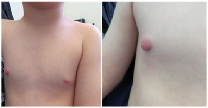 A Child with a Swollen Nipple: A Quiz | HTML | Acta Dermato-Venereologica