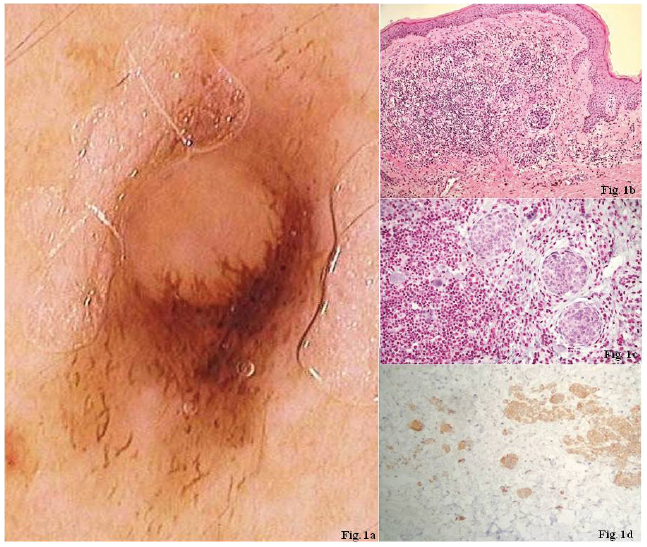 current research on malignant mesothelioma