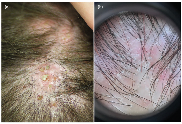 follicular hyperkeratosis face