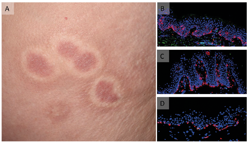 psoriasis hypopigmentation