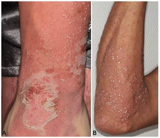 pustular psoriasis remission