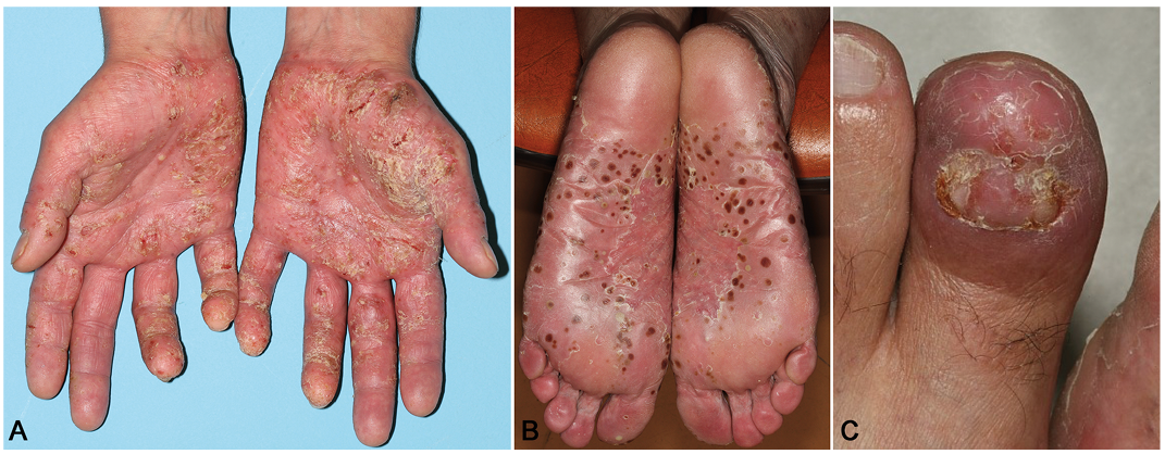 palmar plantar psoriasis