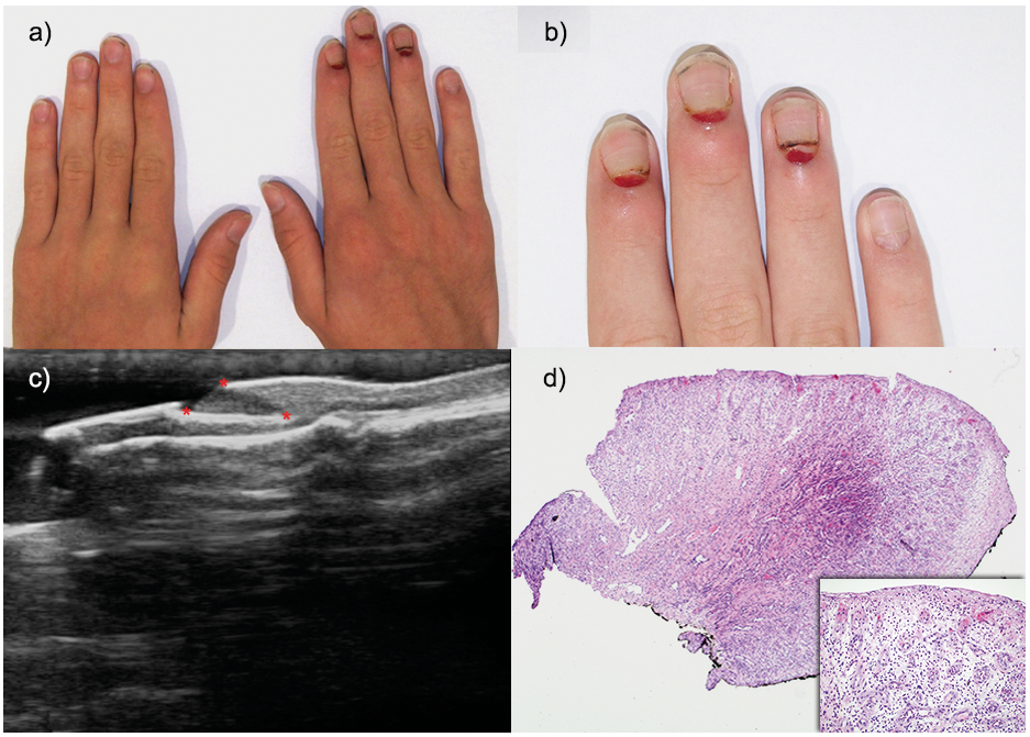Multiple Eruptive Pyogenic Granulomas on the Proximal Nail Folds Following  Cast Immobilization: A Case Report with Nail Unit Ultrasound Findings |  HTML | Acta Dermato-Venereologica