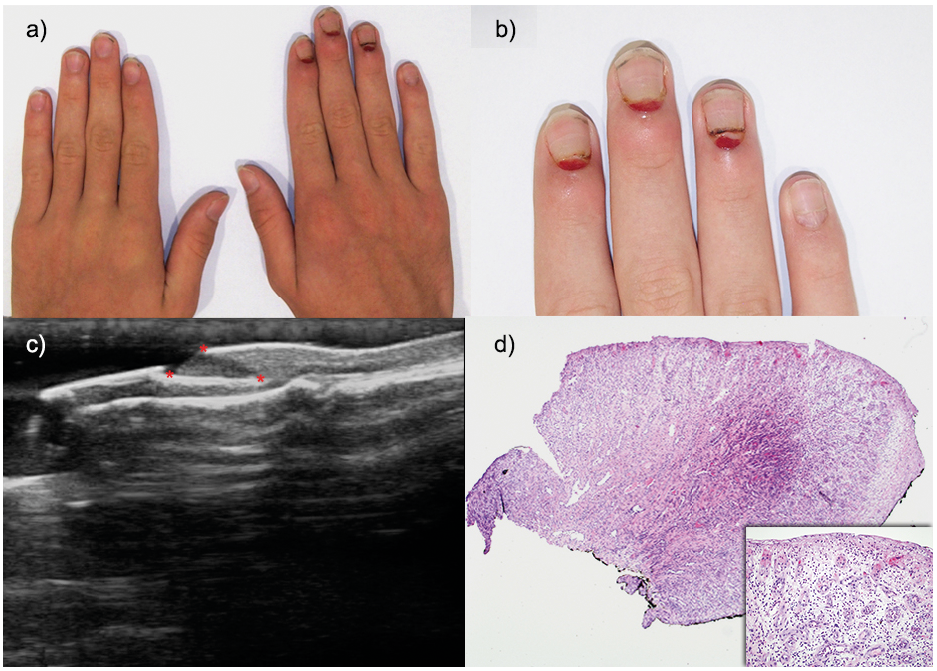 Transverse Leukonychia and Beau Lines Following COVID-19 Vaccination |  MDedge Dermatology