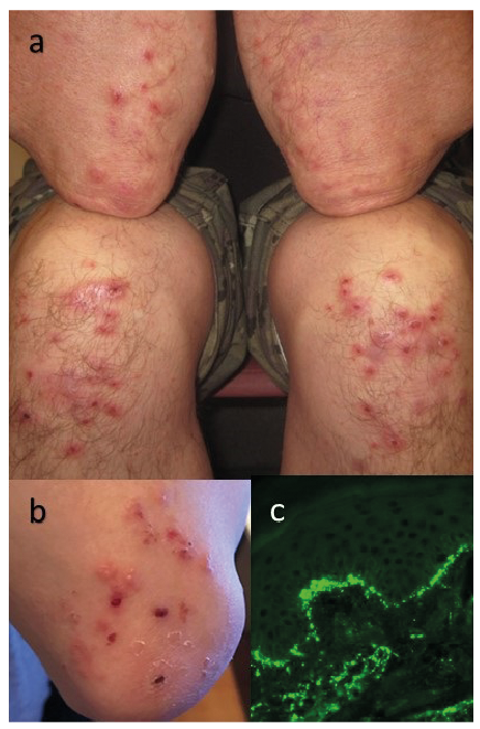 herpetiform dermatitis duhring