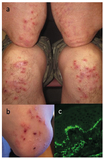 herpetiform dermatitis duhring a szélessávú meghajtó megelőzése