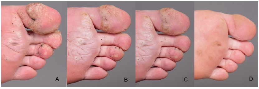 Wart on foot between toes