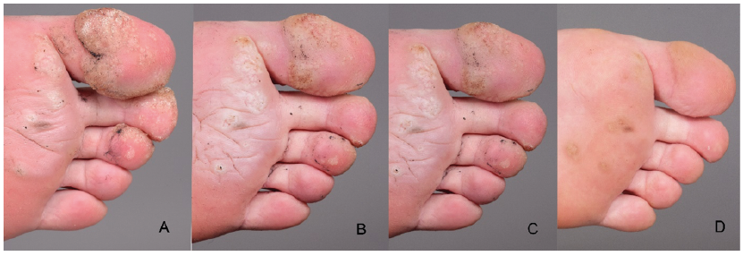 human papillomavirus vaccine and warts