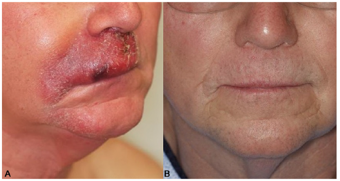 Pilot Study of a Novel Therapeutic Approach for Refractory Advanced Stage  Folliculotropic Mycosis Fungoides | HTML | Acta Dermato-Venereologica