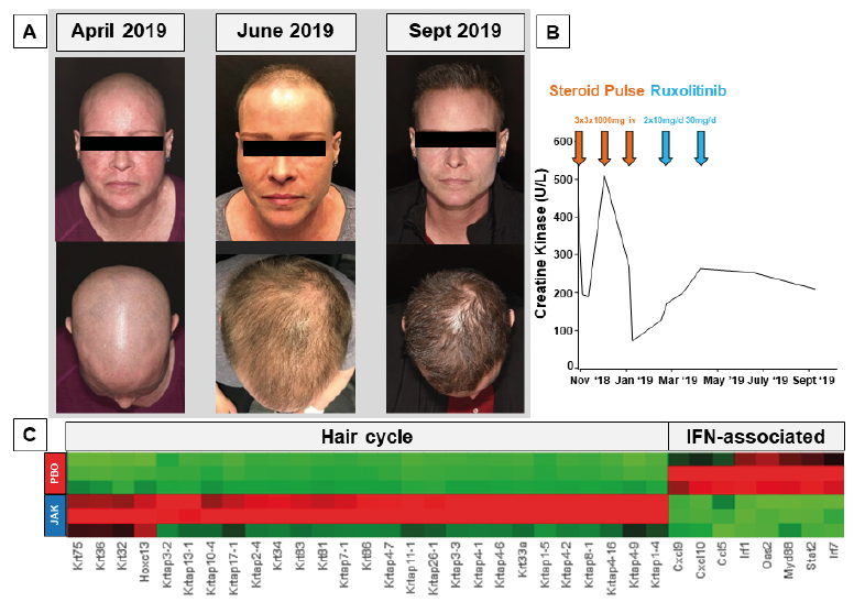 Unexpected Hair Regrowth in a Patient with Longstanding Alopecia Universalis During Treatment of Recalcitrant Dermatomyositis with the Janus Kinase Inhibitor Ruxolitinib | HTML | Acta Dermato-Venereologica Unexpected Hair Regrowth in a Patient with Longstanding Alopecia Universalis During Treatment of Recalcitrant Dermatomyositis with the Janus Kinase Inhibitor Ruxolitinib | HTML | Acta Dermato-Venereologica