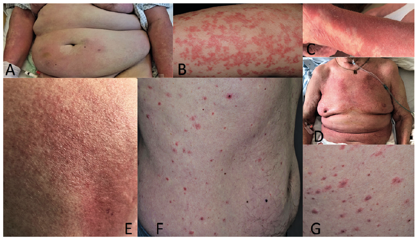 diffuse erythematous rash