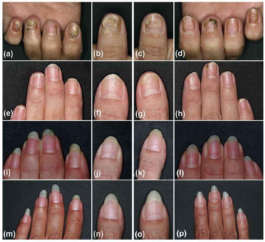 tazarotene for nail psoriasis a kezek bőrén vörös foltok formájában viszketéssel a felnőtteknél