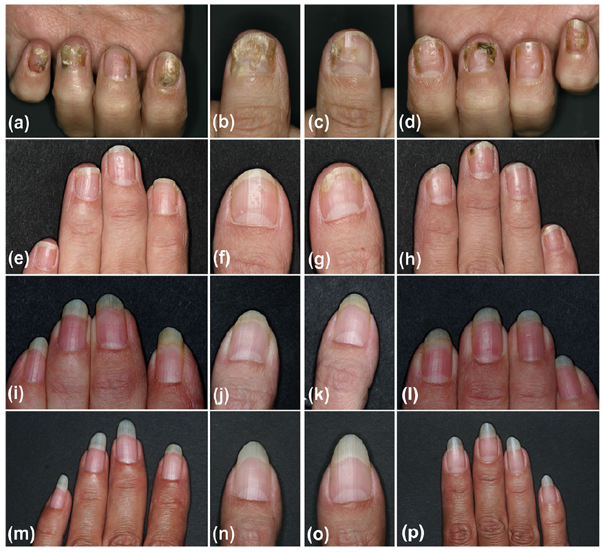 Dermoscopic images showing common features of normal nail and nail... |  Download Scientific Diagram