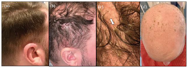Massive Acute Alopecia of the Scalp in a Patient Treated with Dupilumab |  HTML | Acta Dermato-Venereologica