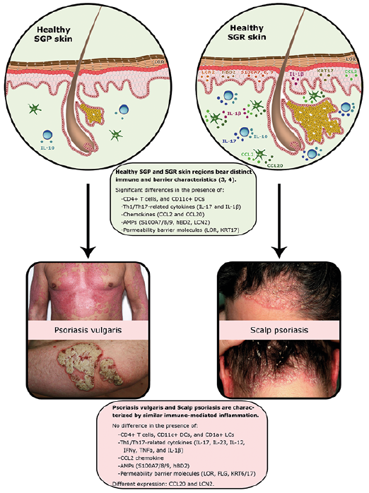 scalp psoriasis and immune system