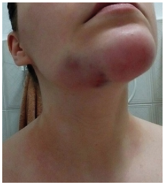 painful bruising syndrome painful bruising syndrome