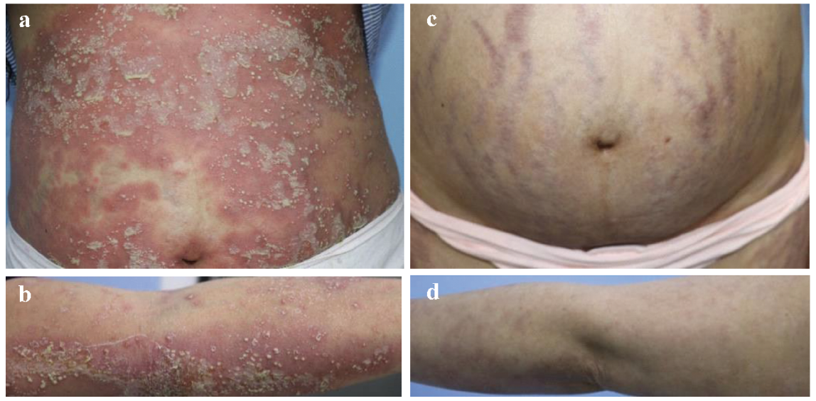 can you get psoriasis after pregnancy
