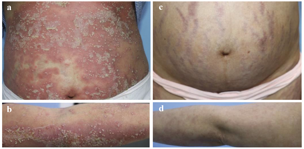 developed psoriasis during pregnancy)