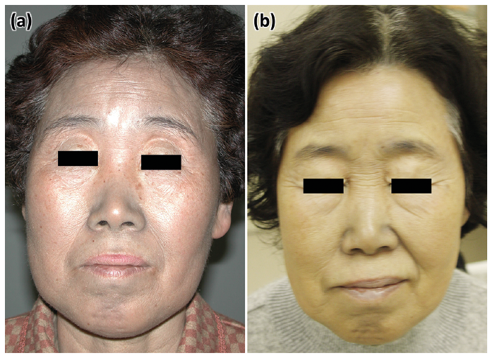 What is argyria, a condition that turns skin colour to blue?