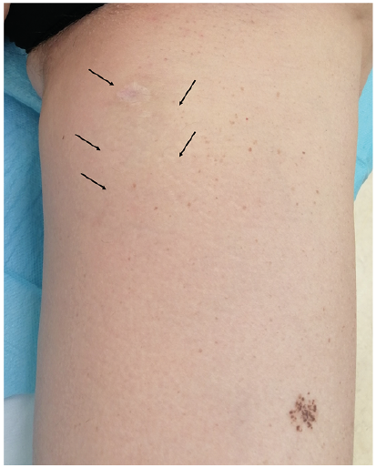 Nodules on the Thigh after Brown Recluse Spider Venom Bite: A Quiz, HTML