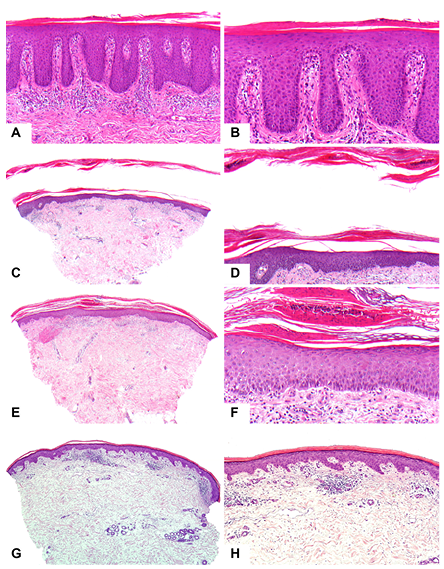 Methodological refinement of Aldara-induced psoriasiform dermatitis model in mice.