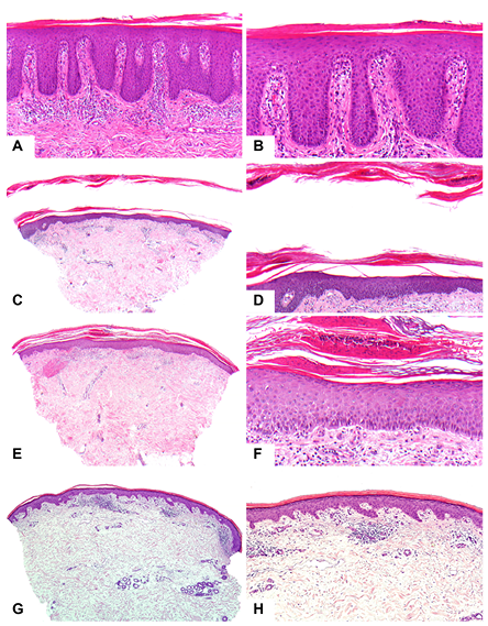 Kis plakk parapsoriasis hisztopathology pdf